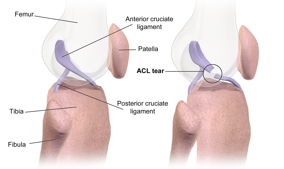 At left is a healthy ACL; at right is what a torn ACL looks like. Create Commons image from Wikimedia Commons.